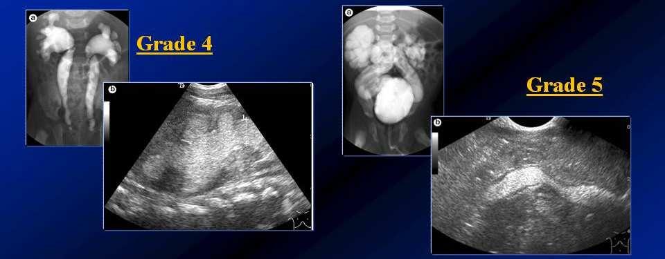 CE voiding urosonography: Diagnosis and F/U of VUR Voiding sono-cystograhy: detection of V U R VUR detection with VUS (Grade 1-5): Grade 1. Microbubbles in the ureter, only Grade 2.