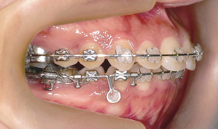 Figure 3. The maxillary en-masse retraction in the headgear group. A, The mandibular arch was stabilized for the use of Class II elastics.