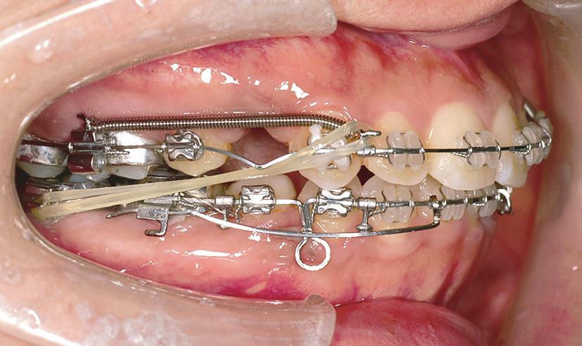 steel closed coil springs, which were stretched twothirds of the distance from the maxillary first molars to the crimpable hooks located mesial to the canines.