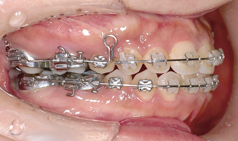 018 0.025-inch stainless steel archwire with keyhole loops was used for root control in the extraction sites, torque control of the maxillary anterior teeth, and final space closure.