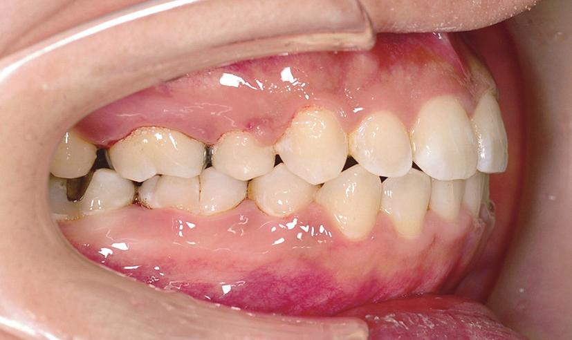 Statistical analyses To evaluate the effectiveness of orthodontic treatment in subjects who had undergone level anchorage system treatment with two different anchorage systems, the en-masse