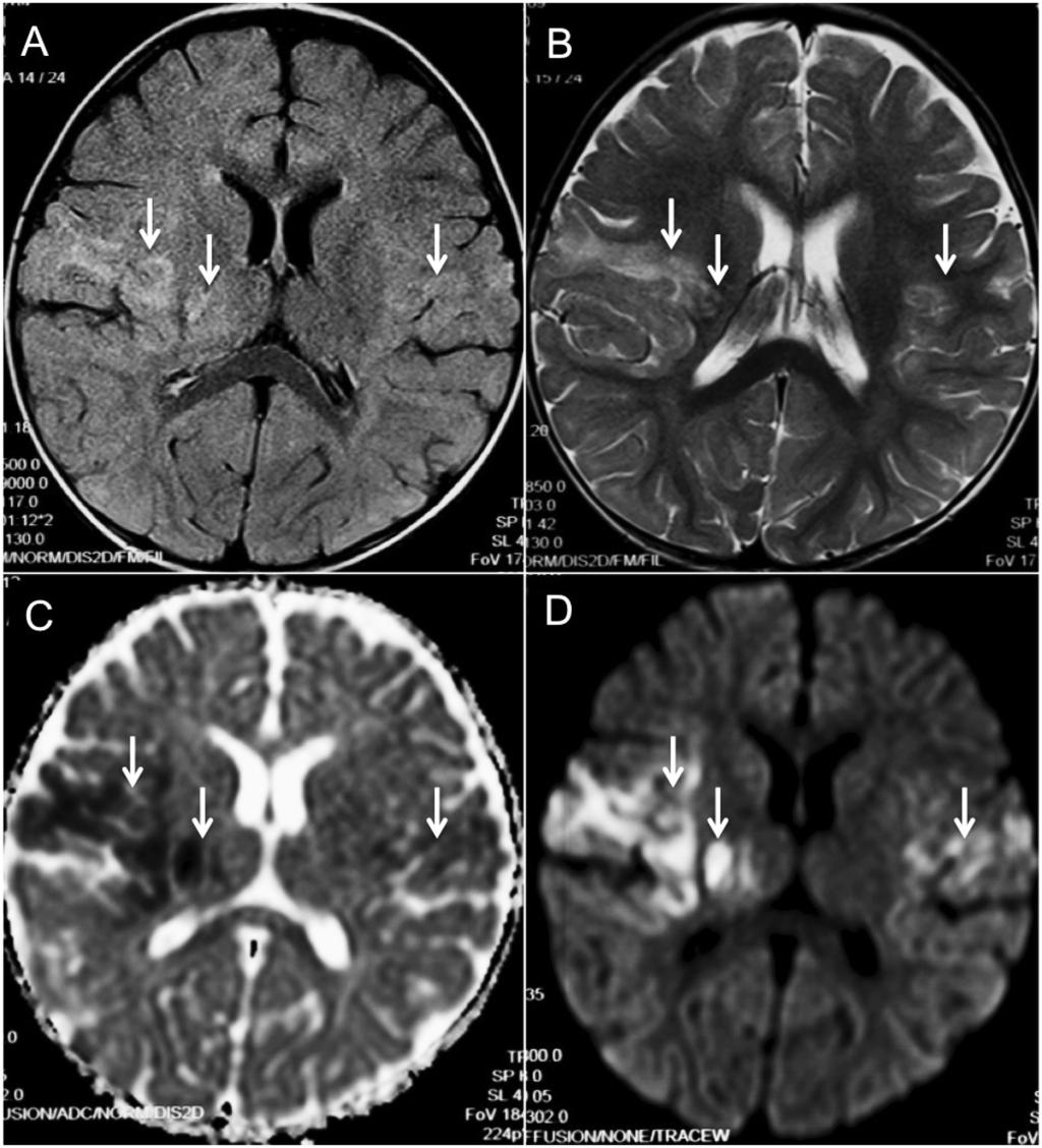 Neurology Asia June 2018 Figure 1. MRI images on day 1 of admission. The axial (A) FLAIR and (B) T2 W images showing ill-defined high signal changes in both frontal lobes and right basal ganglia.