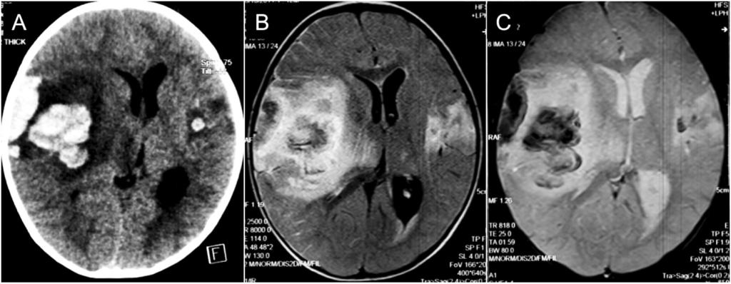 Figure 2. CT and MRI images after 1-week. The (A) axial plain CT brain shows haemorrhagic transformation of the lesions with significant mass effect.