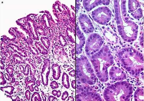 Types of dysplasia in Barrett s oesophagus Adenomatous type Gastric foveolar type. Crypt dysplasia. Mixed?
