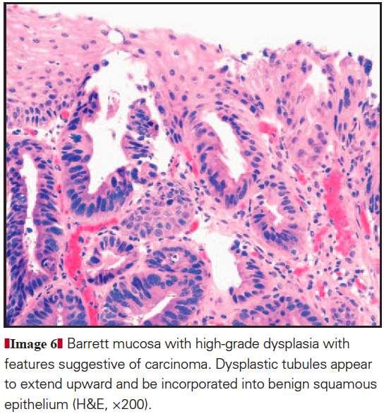5. Pagetoid infiltration of squamous