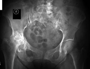 Hip Osteoarthritis Degenerative hip disease is the most common diagnosis