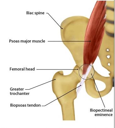 Internal Snapping Hip Syndrome The iliopsoas tendon