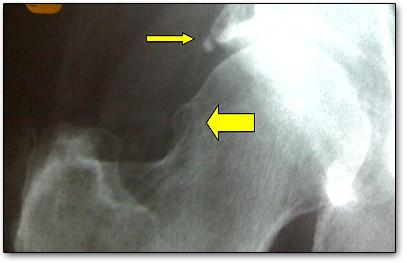Hip Impingement Hip impingement comes in three common varieties: cam, pincer, and combined. Cam impingement is an extra bump of bone on the femoral head.