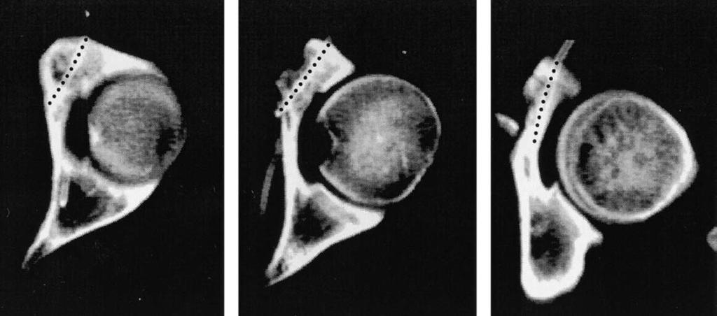 Figure 3. Bone computed tomography scan of the left acetabulum for dosimetry.