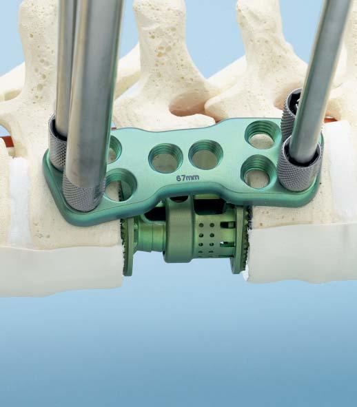 Insert the awl through the drill guide applicator and perforate the bony cortex of the vertebral body. Light impaction may be necessary.