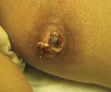 Case 3 An Ulcerated Nodule on the Thigh A 36-year-old, HIV-positive man presents with an ulcerated nodule on his left thigh.
