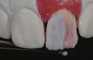 Seven Steps to a Successful Shade Match Fig 5-23 Dentinal ceramic material is layered with incisal enamel and special
