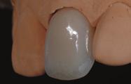 Fig 5-25 Second ceramic buildup with opal transparent powders (HeraCeram [Heraeus-Kulzer-Jelenko, Armonk, NY]).