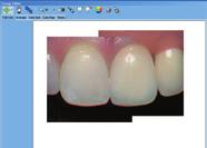 left central incisor. (c) Virtual try-in confirms a visual match.