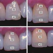 Two crowns were made for the implant abutment at the site of the maxillary right central incisor with an incorrect match; the crown in Fig 5-1 is too opaque and yellowish, and the crown in Fig 5-2 is