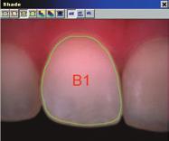 Coarse (basic), fine, gingival/body/incisal (GBI), and inferred translucency maps are
