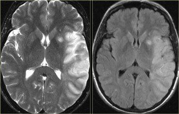 MRI SCAN Imaging in stroke High T2 and
