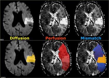 Imaging in stroke MRI SCAN Perfusion