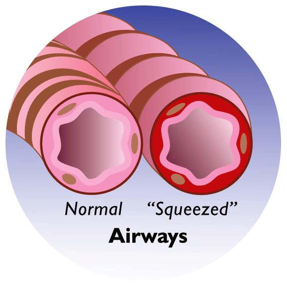 How Asthma Affects the Lungs Airways in the lungs