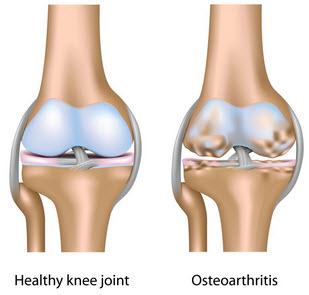 to movement). The normal breakdown of cartilage tissue through years of walking, running and jumping cause infection and injury to the joints.