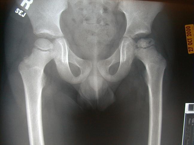 Causes of Hip Pain Legg-Calvé-Perthes Disease Idiopathic AVN of the femoral head Males>females, age