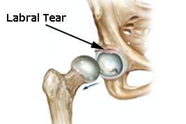 Causes of Hip Pain Labral tear Mechanism of twisting, cutting, or planting