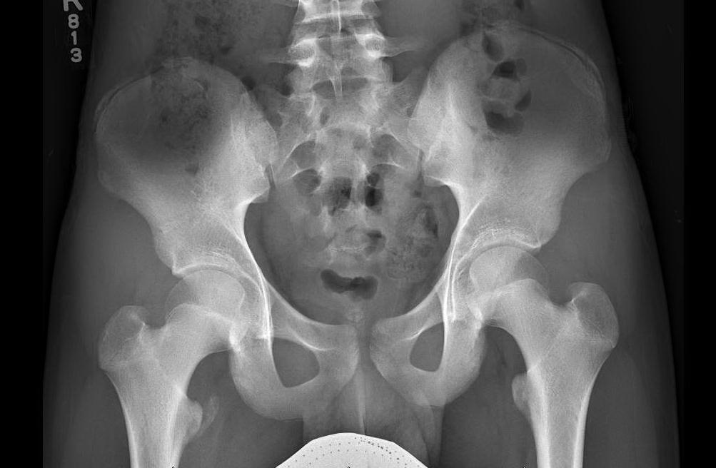 Causes of Hip Pain Avulsion