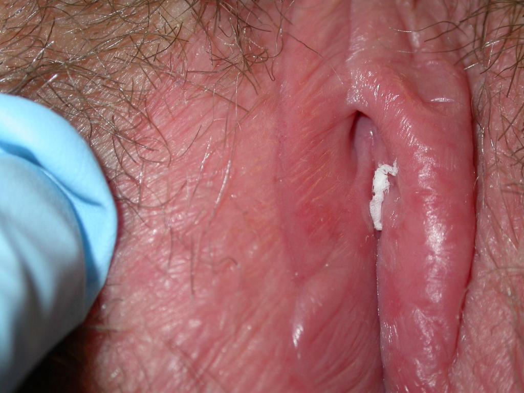 Vulval