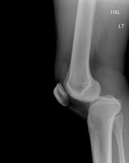 Multiligamentous knee dislocation Uncommon injury in sport Heterogenous group of injuries NV