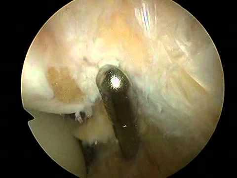Patella tendinopathy Management rarely surgical Role of injections PRP Dextrose Open excision for