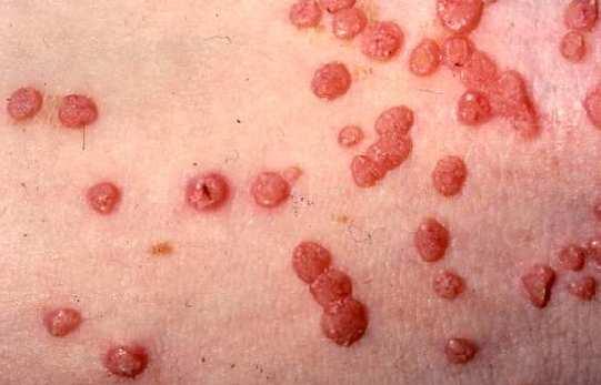 Dermatology - Molluscum Contagiosum Patient Pathway draft updated Dec 2007 Patient Presentation Molluscum Contagiosum is a common pox virus infection of the skin.