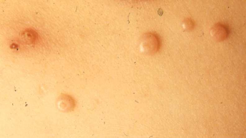 Eczema around molluscum contagiosum MANAGEMENT In the majority of the cases no treatment is required as spontaneous resolution occurs.