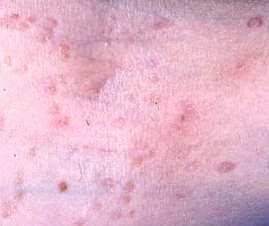 ? Refer Secondary Care Criteria for referral to Dermatologist Diagnostic uncertainty Extensive, painful, inflamed lesions Immunosuppressed patients Resolving molluscum contagiosum Therapeutic tips: