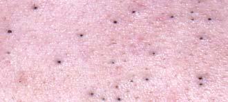 Dermatology - Acne Patient Pathway April 2005 Non inflamed comedones Patient Presentation More extensive inflamed lesions on face and trunk Deep inflamed cysts and scarring Useful Information for