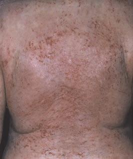 Acute infected eczema Chronic lichenified flexural ezcema Acute erythrodermic eczema Treatment of mild disease: Bath emollients + additional antiseptic Soap substitutes and