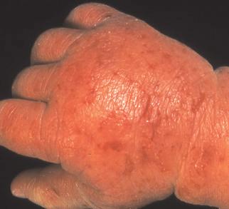 for flares Mild topical steroid for facial eczema consider topical tacrolimus or pimecrolimus if poor response to topical steroid 1% Ichthammol in zinc ointment / paste