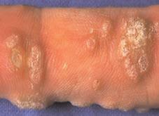 Dermatology - Viral Warts Patient Pathway April 2005 Warts are caused by a common viral infection, the human papillomavirus (HPV).
