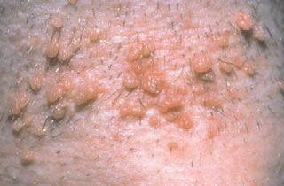 They may vary in appearance depending Common hand warts on the type of HPV, the anatomical site involved and the host immune response.