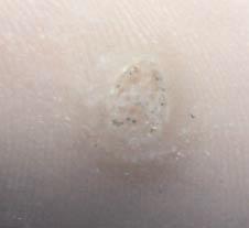 with viral warts can be managed in primary care.