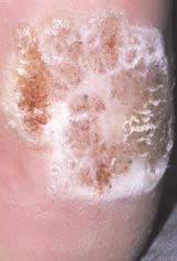 warts Continue treatment for at least Consider 3 weekly cryotherapy but use in combination with topical three months by practice nurse therapy.