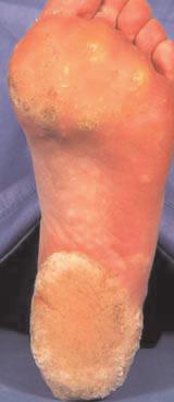 to practice nurse for consideration of cryotherapy three weekly for up to 10 treatments: single or double freeze thaw cycle Patients with painful plantar warts