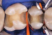 right first molar) after removal of the old, fractured restorations.