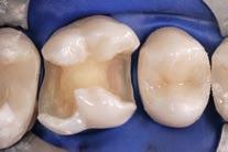Subsequent removal of the matrix facilitated anatomical modelling of the occlusal contours.