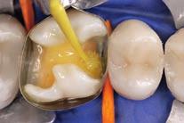 A comparison of the two restored teeth demonstrates that similar results can be achieved with siloranes in