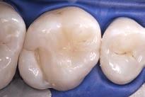 12 Case 4: Minimally invasive restorative treatment with Filtek Silorane The following clinical case study describes the restorative treatment performed following excavation of hidden fissure caries