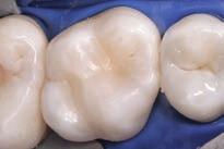 The resulting distal cavity reflects the extent of the severely undermining caries.