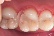 Case 1: Cusp build-up with Filtek Silorane This case study focuses on the restoration of an upper molar.