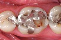 Case 2: Amalgam replacement with Filtek Silorane The following clinical case highlights the