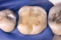 Following caries removal and preparation of the cavity margins, mesially and distally contoured