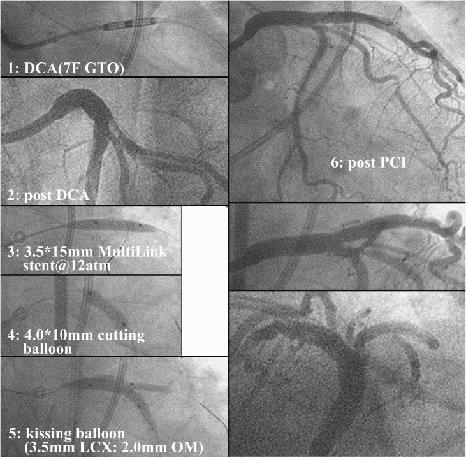 Therefore DCA prior to stenting was planned. After the optimal debulking(60 psi, removed tissue weight 31.